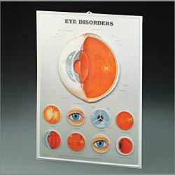 Eye Disorders Lenticular Chart