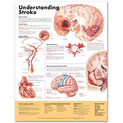 Understanding Stroke 2E, 20x26 Laminated "