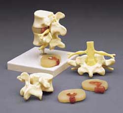 LUMBAR VERTEBRAE W/HERNIATED DISC