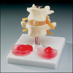 LUMBAR SET WITH 3 DISCS