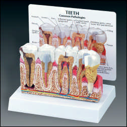 DISEASED TEETH & GUM MODEL WITH CARD