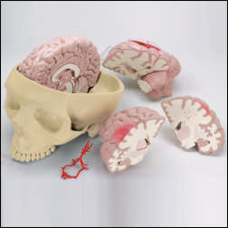 DISEASED BRAIN MODEL WITH CARD