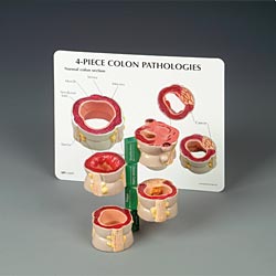 4-PIECE COLON SET W/PATHOLOGIES NEW 2009